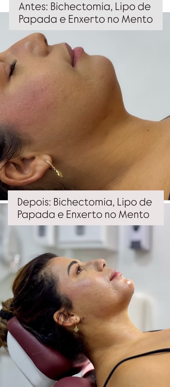 Caso 02 — Bichectomia + Lipo de Papada + Enxerto no Mento — foto 1