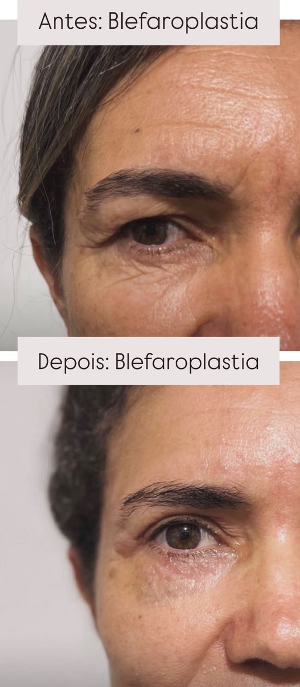 Caso 01 — Pálpebras superiores — foto 1