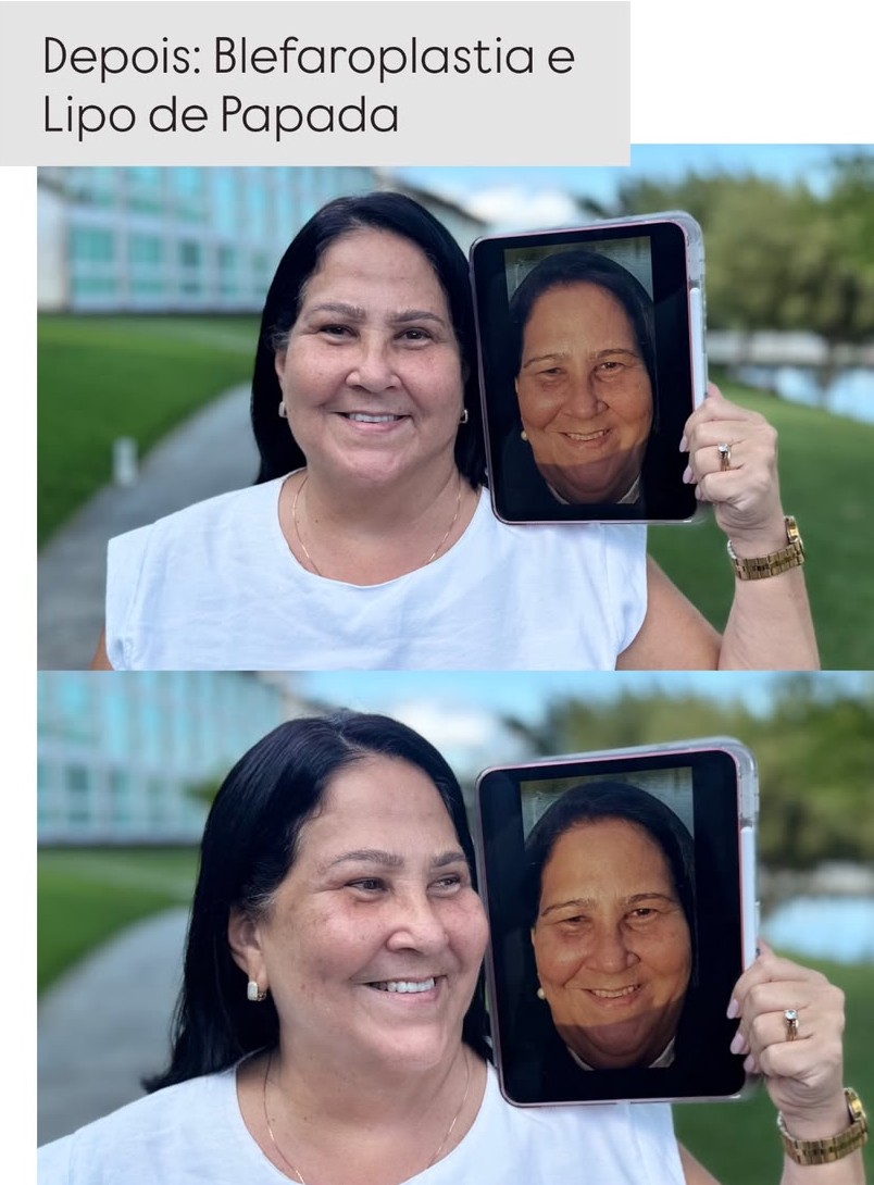 Caso 02 — Blefaroplastia + Lipo de Papada — foto 1