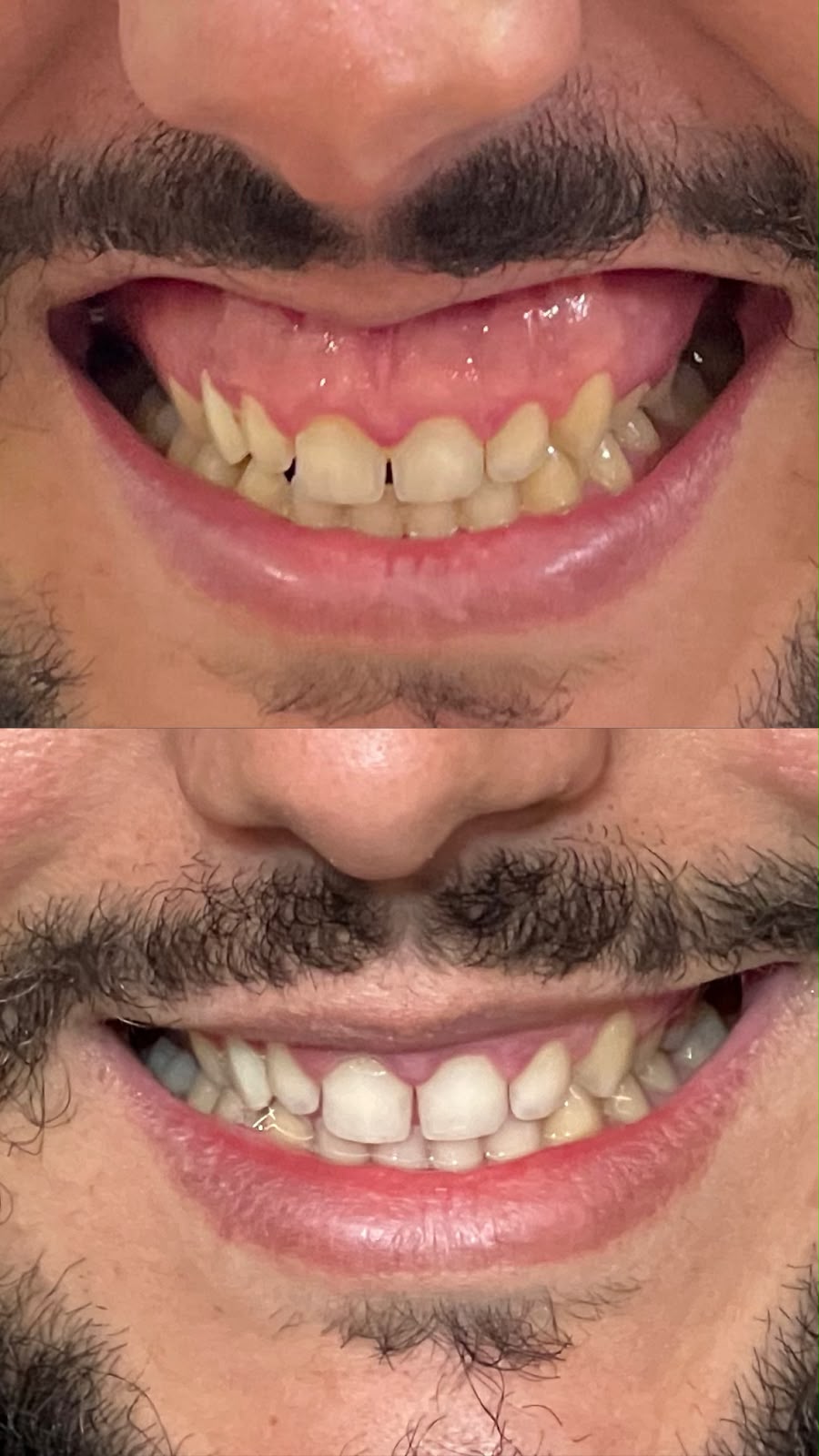 Caso 02 — Sorriso gengival — foto 1