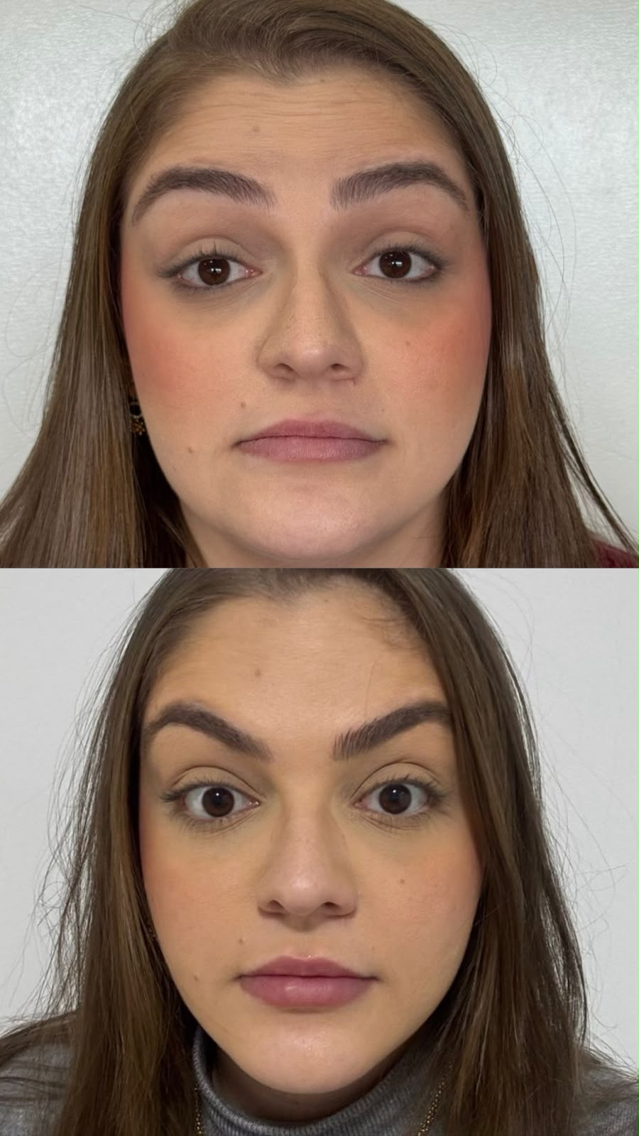Caso 03 — Harmonização facial — foto 1
