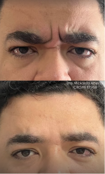 Botox Estético