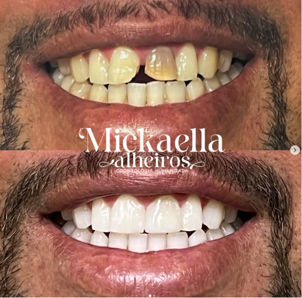Caso 03 — Reconstrução de sorriso — foto 1